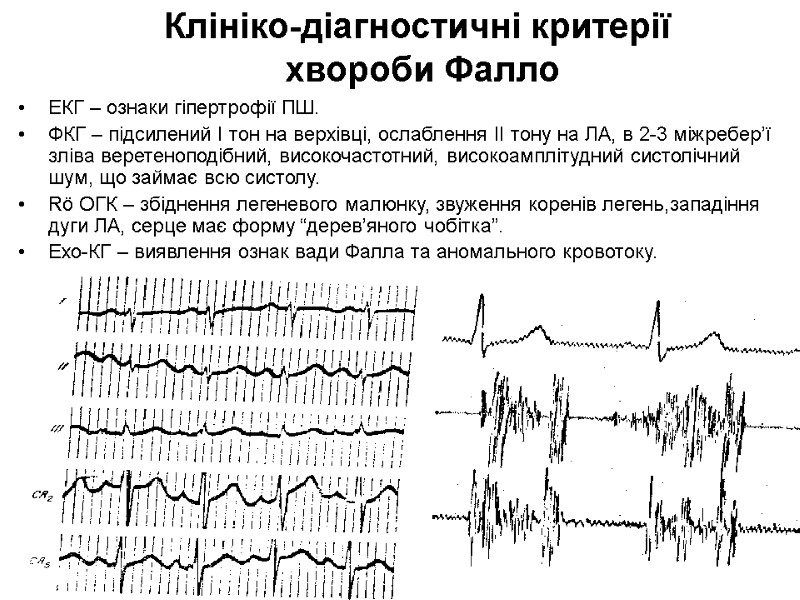 Клініко-діагностичні критерії  хвороби Фалло ЕКГ – ознаки гіпертрофії ПШ.  ФКГ – підсилений